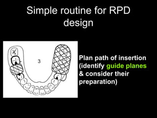 Rrpd Project PPT (FINAL)The principles of RPD design & its components (Year 3) .pptx