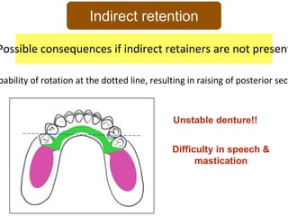 Example Indirect Retention In Rpd PPT (FINAL)The principles of RPD design & its components (Year 3) .pptx
