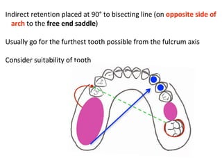Example Indirect Retention In Rpd PPT (FINAL)The principles of RPD design & its components (Year 3) .pptx