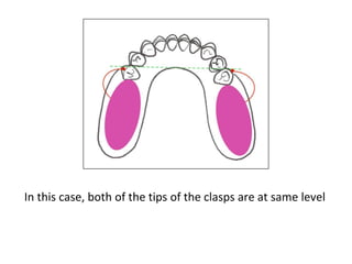 G Clasp Rpd PPT (FINAL)The principles of RPD design & its components (Year 3) .pptx