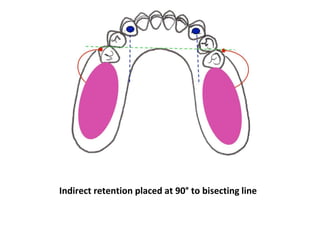 Example Indirect Retention In Rpd PPT (FINAL)The principles of RPD design & its components (Year 3) .pptx