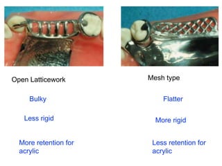 Lattice Rpd PPT (FINAL)The principles of RPD design & its components (Year 3) .pptx