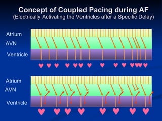 Concept of Coupled Pacing during AF (Electrically Activating the Ventricles after a Specific Delay) Atrium Ventricle AVN                       Atrium Ventricle AVN 