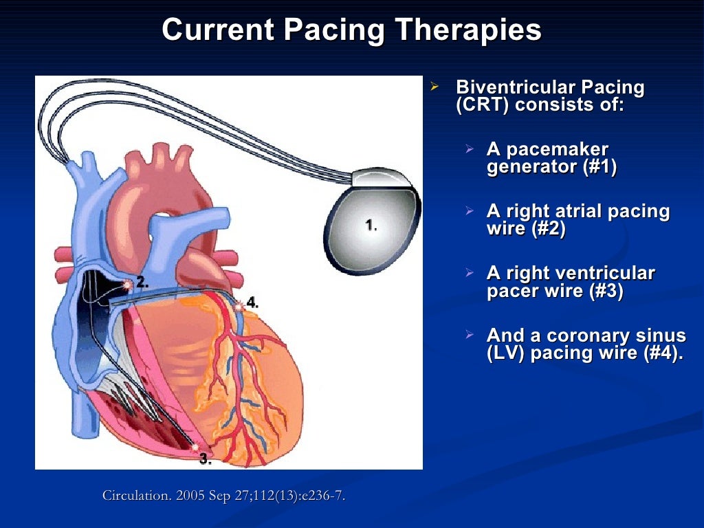 PPT for cardiac pacing