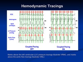 Hemodynamic Tracings Marks above the left ventricular (LV) pressure tracings illustrate VRMC, and marks above the aortic flow tracings illustrate VREJ. 