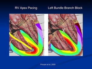 RV Apex Pacing Left Bundle Branch Block Prinzen et al, 2000 