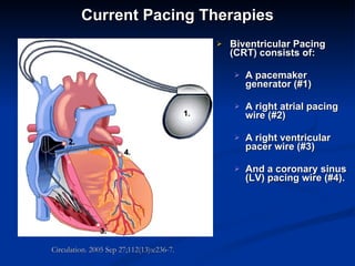 Current Pacing Therapies Biventricular Pacing (CRT) consists of: A pacemaker generator (#1) A right atrial pacing wire (#2) A right ventricular pacer wire (#3) And a coronary sinus (LV) pacing wire (#4). Circulation. 2005 Sep 27;112(13):e236-7.  