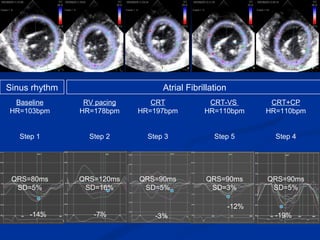 RV pacing HR=178bpm Step 2 QRS=120ms SD=16% CRT+CP HR=110bpm Step 4 QRS=90ms SD=5% CRT-VS  HR=110bpm Step 5 QRS=90ms SD=3% -12% -7% -14% Baseline HR=103bpm Step 1 QRS=80ms SD=5% Atrial Fibrillation Sinus rhythm Dog  #176 CRT HR=197bpm Step 3 QRS=90ms SD=5% -3% -19% 