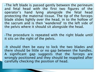 The left blade is passed gently between the perineum
and fetal head with the first two figures of the
operator’s hand lying alongside the fetal head
protecting the maternal tissue. The tip of the forceps
blade slides lightly over the head, in to the hollow of
the sacrum and is then ‘wandered’ to the left side of
the pelvis where it should sit alongside the head.
The procedure is repeated with the right blade until
it sits on the right of the pelvis.
It should then be easy to lock the two blades and
there should be little or no gap between the handles.
A significant gap suggests that the forceps are
wrongly positioned and they should be reapplied after
carefully checking the position of head.
 