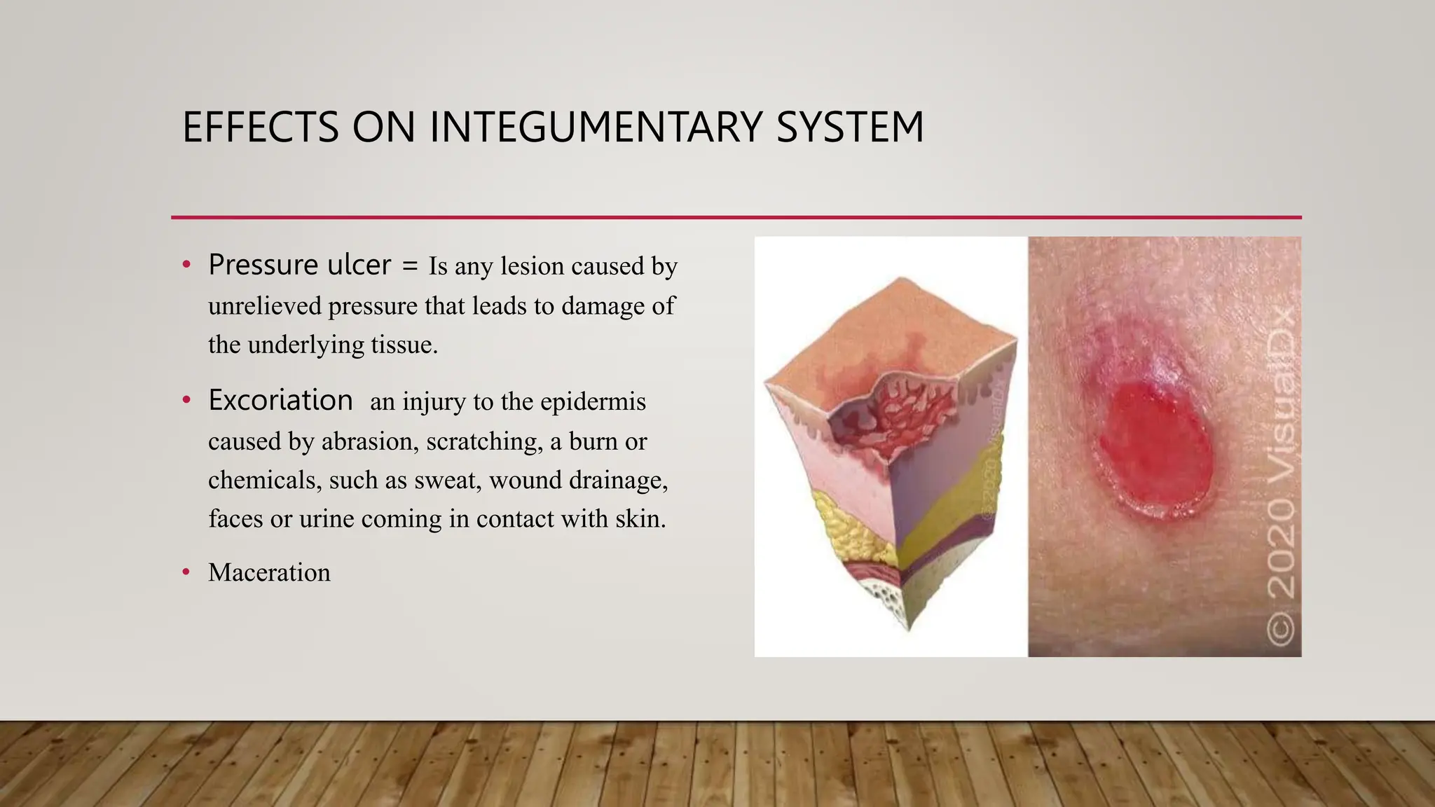 EFFECTS ON INTEGUMENTARY SYSTEM
• Pressure ulcer = Is any lesion caused by
unrelieved pressure that leads to damage of
the underlying tissue.
• Excoriation an injury to the epidermis
caused by abrasion, scratching, a burn or
chemicals, such as sweat, wound drainage,
faces or urine coming in contact with skin.
• Maceration
 