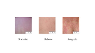 Scarlatine Rubéole Rougeole
 