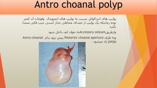 Antro choanal polyp
‫کمتر‬ ‫آن‬ ‫وقوعات‬ ‫اتمیویدال‬ ‫های‬ ‫پولیپ‬ ‫به‬ ‫نسبت‬ ‫انتراکوانل‬ ‫های‬ ‫پولیپ‬
‫منشا‬ ‫فکی‬ ‫جیب‬ ‫انسی‬ ‫جدار‬ ‫مخاطی‬ ‫غشای‬ ‫از‬ ‫پولیپ‬ ‫یک‬ ‫زمانیکه‬ ‫بوده‬
‫بگیرد‬
‫جوف‬ ‫به‬
‫داخل‬ ‫انف‬
‫شود‬ Accessory osteum‫وازطریق‬
‫طرف‬ ‫وبه‬
Posterior choanal aperture
‫بنام‬ ‫برود‬ ‫پیش‬
Antro choanal
polyp
‫میشود‬ ‫یاد‬
.
 