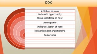 DDX
A blob of mucosa
turbinate hypertrophy
Rhino sporidosis of nose
Meningocele
Malignant lesion of nose
Nasopharyngeal angiofibroma
hamartoma
 