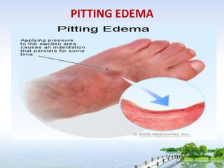 PITTING EDEMA
• Grades of pitting edema
•   Grade 0 : (none)
•   Grade +1 :( trace , 2 mm)
•   Disappear rapidly
•   Grade...