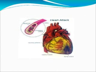 Hints Infarct Comprehensive Overview of Hypertension Crisis and Acute Myocardial ...