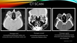CT SCAN
Potongan axial
menunjukkan pembesaran badan otot
extraocular tanpa keterlibatan tendo otot
Potongan coronal
menunjukkan pembesaran otot
extraocular didalam orbita
Potongan sagital
menunjukkan penambahan lemak
intraconal serta pembesaran ringan
otot extraoculer
September 19, 2013
 