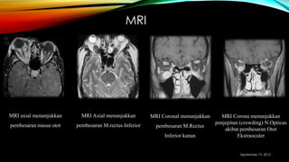 MRI
MRI Corona menunjukkan
penjepitan (crowding) N.Opticus
akibat pembesaran Otot
Ekstraoculer
MRI Coronal menunjukkan
pembesaran M.Rectus
Inferior kanan
MRI Axial menunjukkan
pembesaran M.rectus Inferior
MRI axial menunjukkan
pembesaran massa otot
September 19, 2013
 
