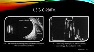 USG ORBITA
USG B-Scan menunjukkan pembesaran M.Rectus Medial
serta visualisasi insersi tendo
USG A-scan yang menunjukkan refleksi sedang
sampai tinggi dari otot ekstra ocular
September 19, 2013
 