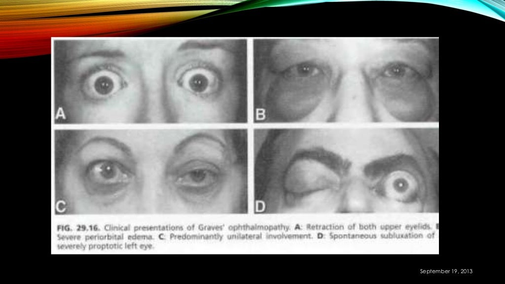 Graves Ophthalmopathy