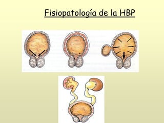 Fisiopatología de la HBP
 