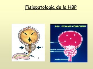 Fisiopatología de la HBP
 