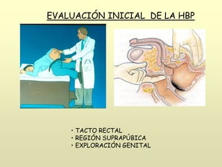 EVALUACIÓN INICIAL DE LA HBP
• TACTO RECTAL
• REGIÓN SUPRAPÚBICA
• EXPLORACIÓN GENITAL
 