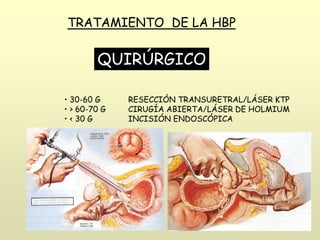TRATAMIENTO DE LA HBP
QUIRÚRGICO
• 30-60 G RESECCIÓN TRANSURETRAL/LÁSER KTP
• > 60-70 G CIRUGÍA ABIERTA/LÁSER DE HOLMIUM
• < 30 G INCISIÓN ENDOSCÓPICA
 