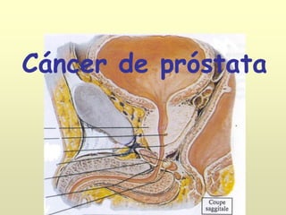 Cáncer de próstata
 
