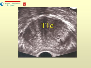 Madrid
Hospital Universitario
12 de Octubre
T1c
 