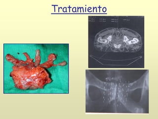 Tratamiento
 