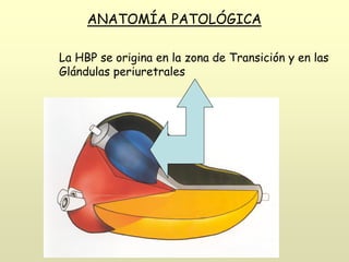 La HBP se origina en la zona de Transición y en las
Glándulas periuretrales
ANATOMÍA PATOLÓGICA
 