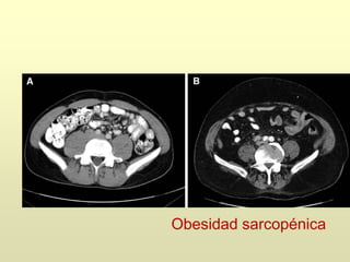 Obesidad sarcopénica
 