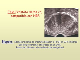 ETR: Próstata de 53 cc,
compatible con HBP.
Biopsia: Adenocarcinoma de próstata Gleason 6 (3+3) en 2/4 cilindros
Del lóbulo derecho, afectados en un 30%.
Resto de cilindros sin evidencia de malignidad.
 
