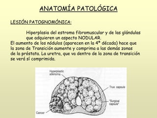 LESIÓN PATOGNOMÓNICA:
Hiperplasia del estroma fibromuscular y de las glándulas
que adquieren un aspecto NODULAR.
El aumento de los nódulos (aparecen en la 4ª década) hace que
la zona de Transición aumente y comprima a las demás zonas
de la próstata. La uretra, que va dentro de la zona de transición
se verá sí comprimida.
ANATOMÍA PATOLÓGICA
 