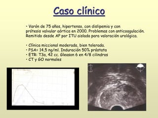 • Varón de 75 años, hipertenso, con dislipemia y con
prótesis valvular aórtica en 2000. Problemas con anticoagulación.
Remitido desde AP por ITU aislada para valoración urológica.
• Clínica miccional moderada, bien tolerada.
• PSA= 14,5 ng/ml. Induración 50% próstata
• ETR: T3a, 42 cc. Gleason 6 en 4/8 cilindros
• CT y GO normales
Caso clínico
 