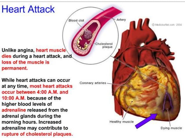 ppt-heart-attack-pptxfinal-2