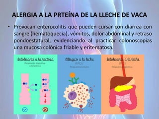 ALERGIA A LA PRTEÍNA DE LA LLECHE DE VACA
• Provocan enterocolitis que pueden cursar con diarrea con
sangre (hematoquecia), vómitos, dolor abdominal y retraso
pondoestatural, evidenciando al practicar colonoscopias
una mucosa colónica friable y eritematosa.
 
