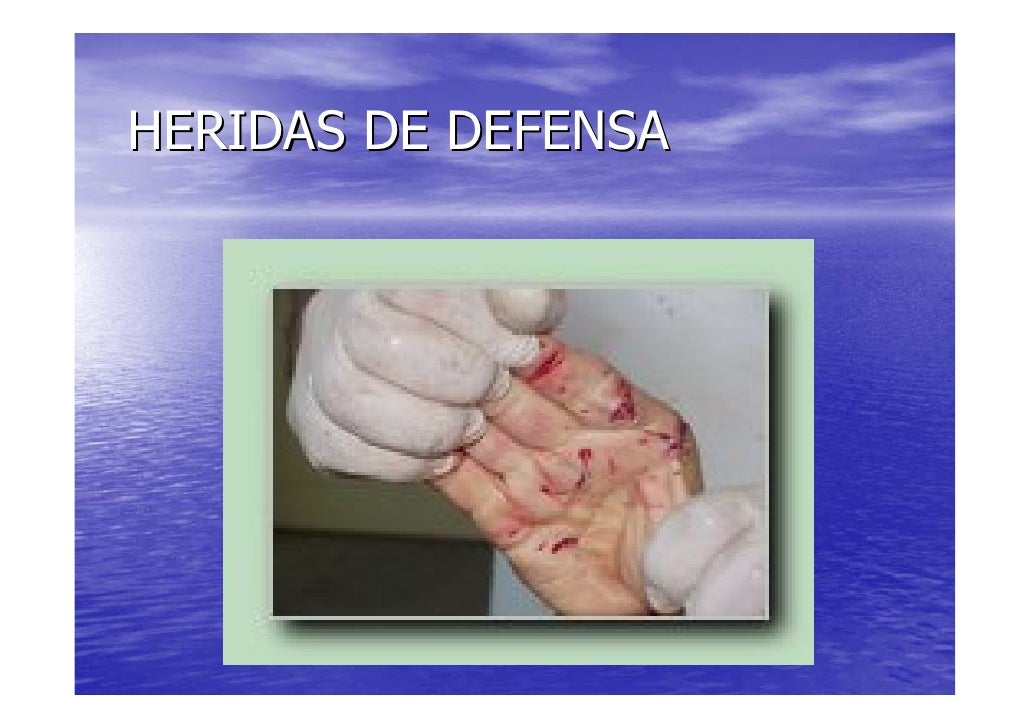 Heridas De Defensa Por Arma Blanca