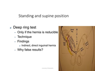 Standing and supine position
University of Alexandria
 Deep ring test
– Only if the hernia is reducible
– Technique
– Findings
 Indirect, direct inguinal hernia
– Why false results?
 