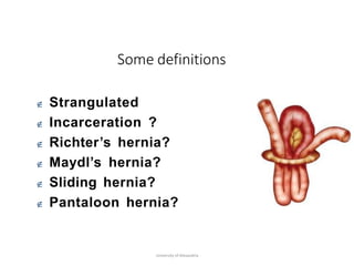 Some definitions
University of Alexandria
 Strangulated
 Incarceration ?
 Richter’s hernia?
 Maydl’s hernia?
 Sliding hernia?
 Pantaloon hernia?
 