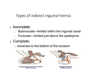 Types of indirect inguinal hernia
University of Alexandria
 Incomplete;
–
–
Bubonocele—limited within the inguinal canal
Funicular—limited just above the epididymis
 Complete;
– traverses to the bottom of the scrotum
 
