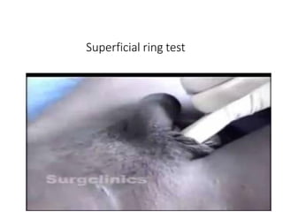 Superficial ring test
University of Alexandria
 