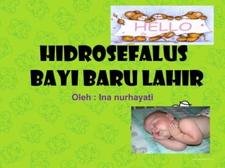 Hidrosefalus
Bayi Baru Lahir
Oleh : Ina nurhayati

 