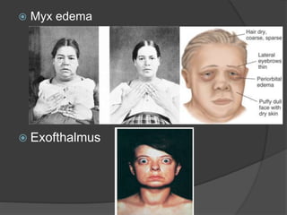  Myx edema
 Exofthalmus
 