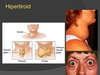 Hipertiroid
 