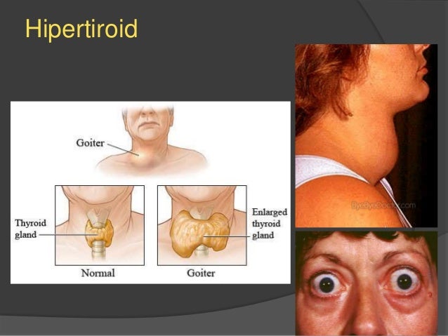 Ppt hipotiroid dan hipertiroid 
