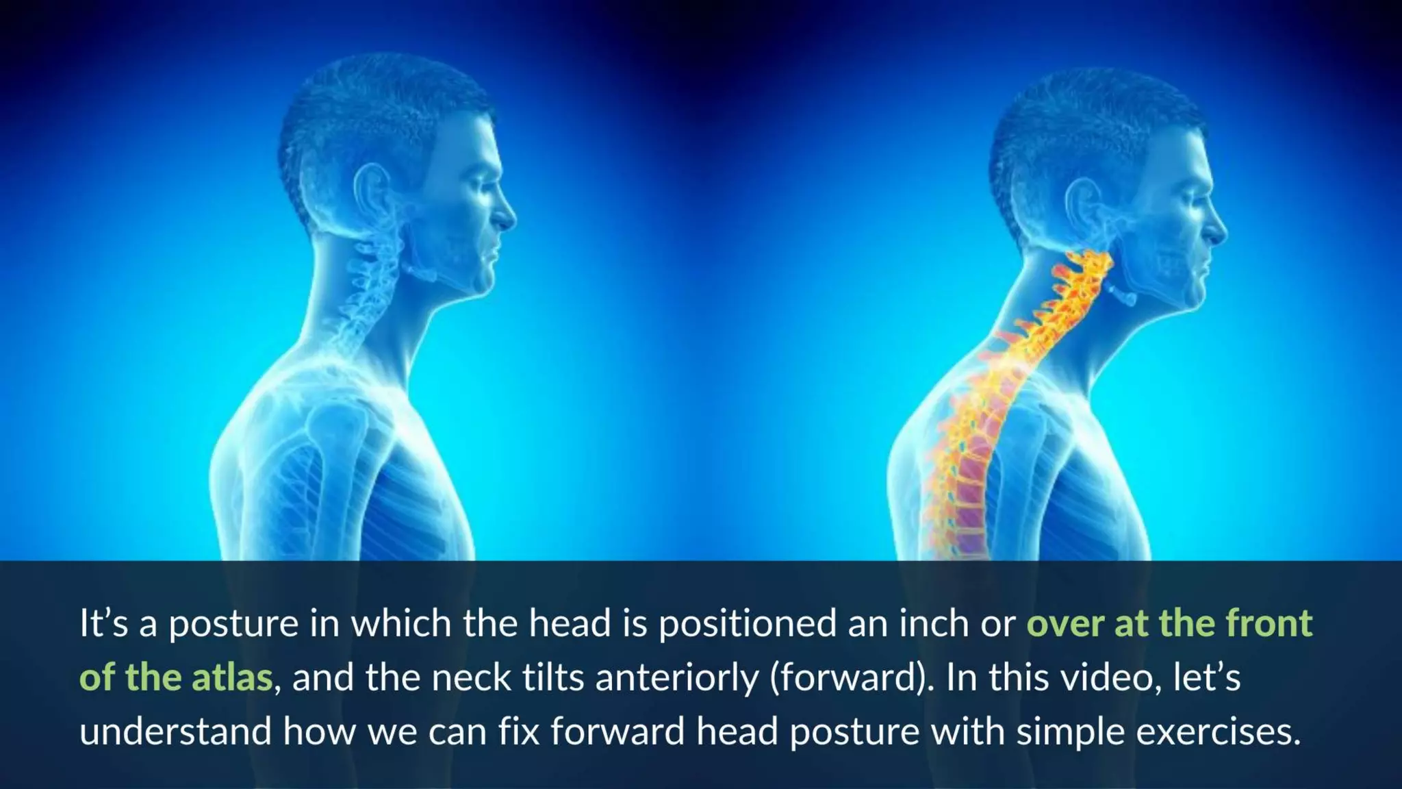 How To Fix Forward Head Posture? 3 Easy Exercises (From a Chiropractor)