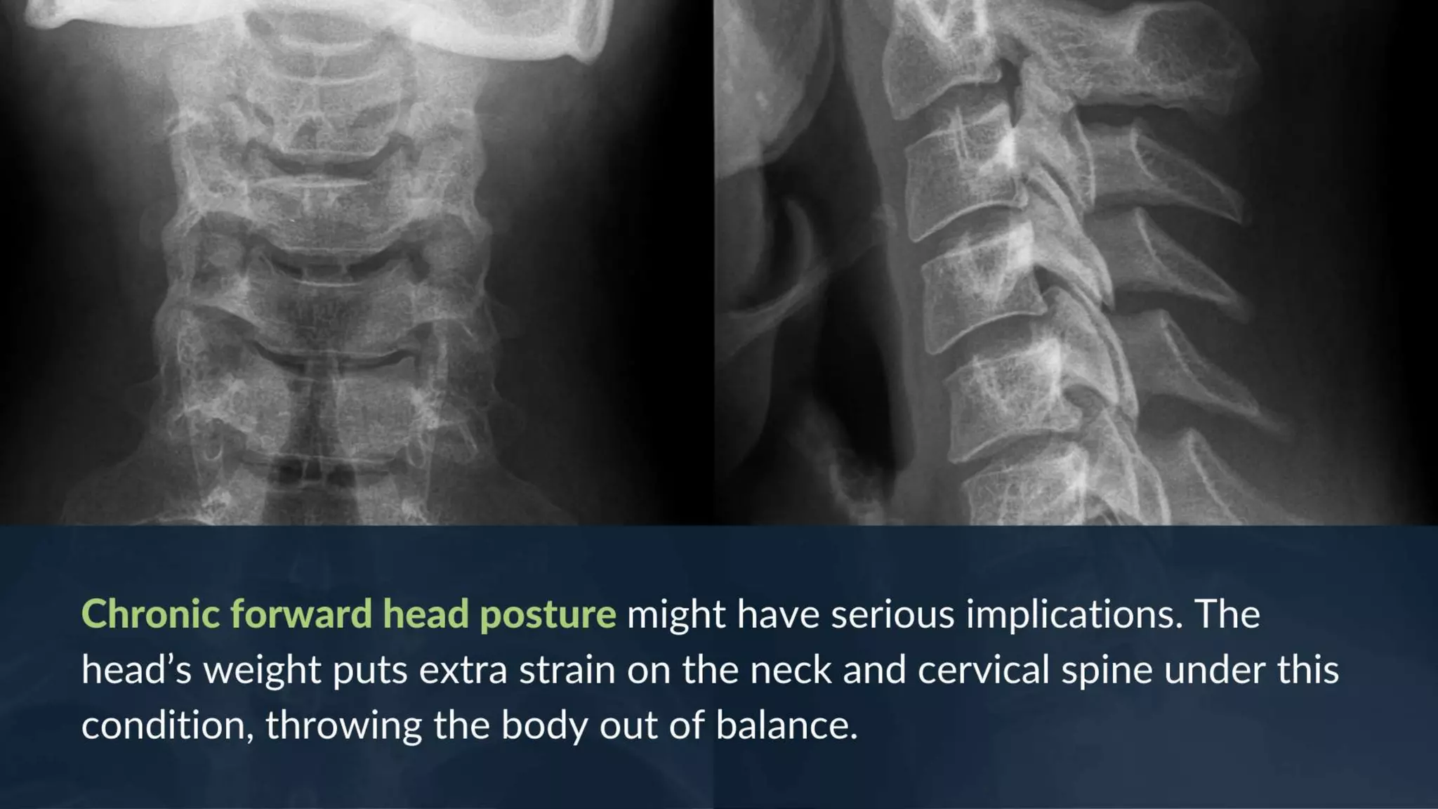 How To Fix Forward Head Posture? 3 Easy Exercises (From a Chiropractor)