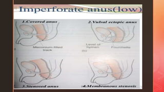 PPT Imperforated Anus.pptx