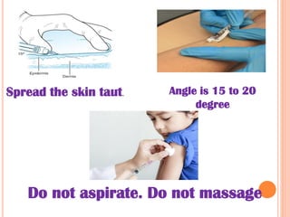 Spread the skin taut. Angle is 15 to 20
degree
Do not aspirate. Do not massage
 